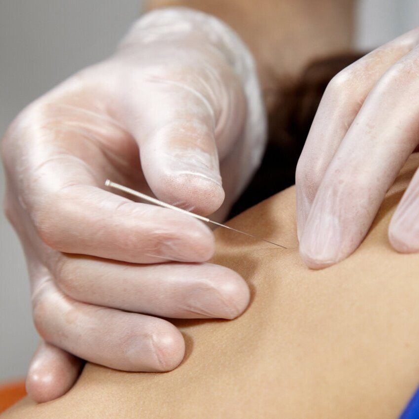 Dry Needling at Maletta Pfeiffer Physical Therapy